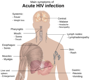 Anal HIV Symptoms Diagram 